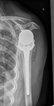 Inverse Schulter TEP_y_view Inverse Schulter TEP_y_view